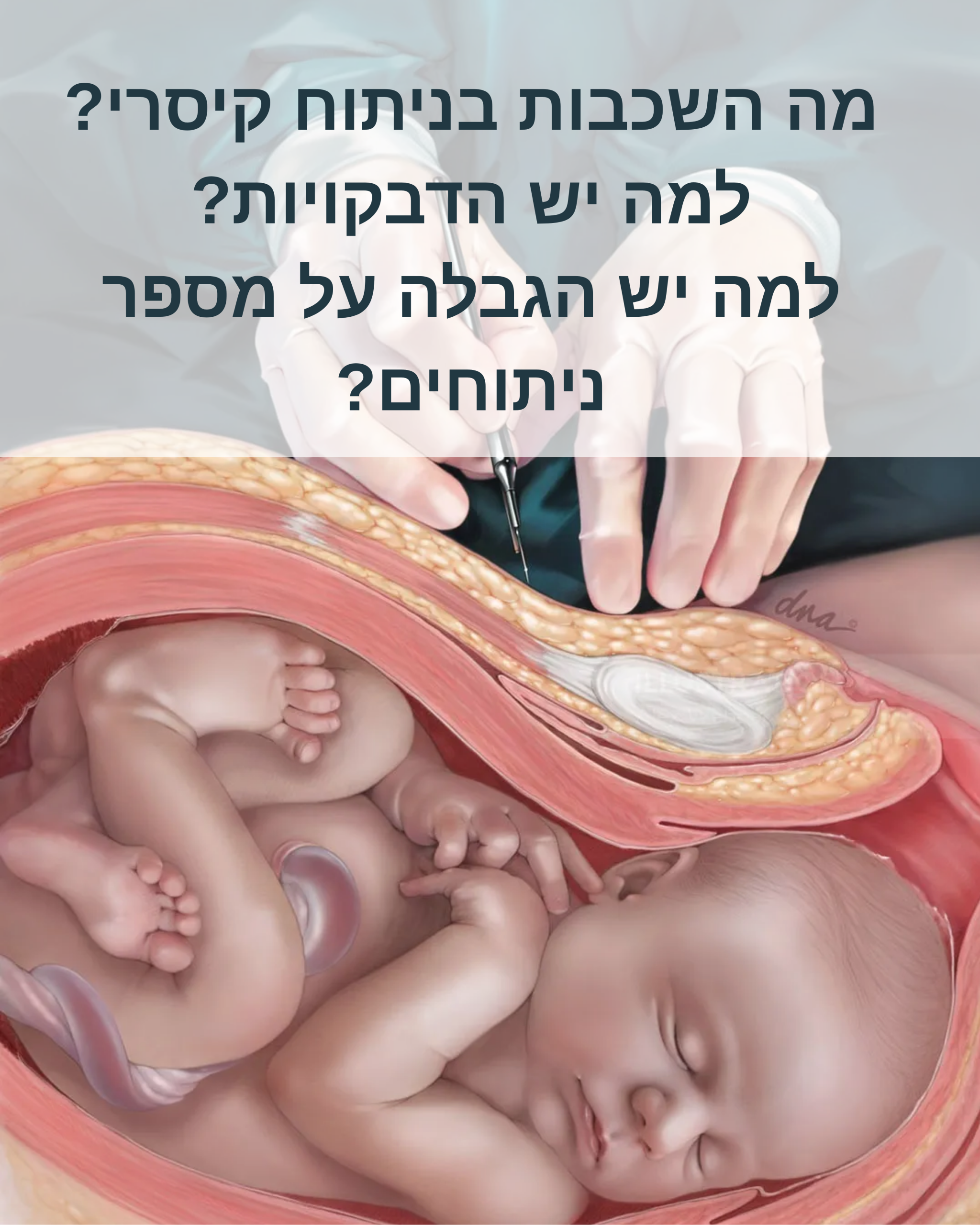 השכבות בניתוח קיסרי